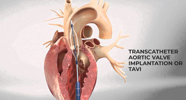 What You Need to Know About Transcatheter Aortic Valve Implantation or TAVI
