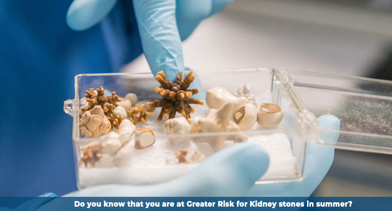 Do you know that you are at Greater Risk for Kidney stones in summer?
