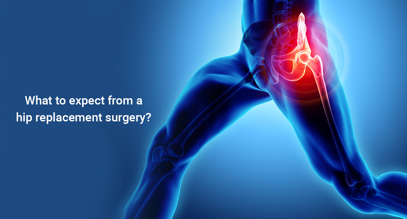 What to expect from a hip replacement surgery?