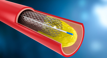 All You Need To Know About Coronary Angioplasty