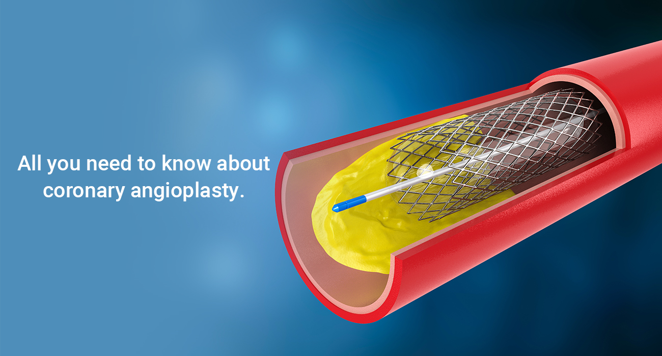 All You Need To Know About Coronary Angioplasty
