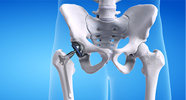 What is the importance of a Hip Joint and who requires Hip Replacement Surgery?