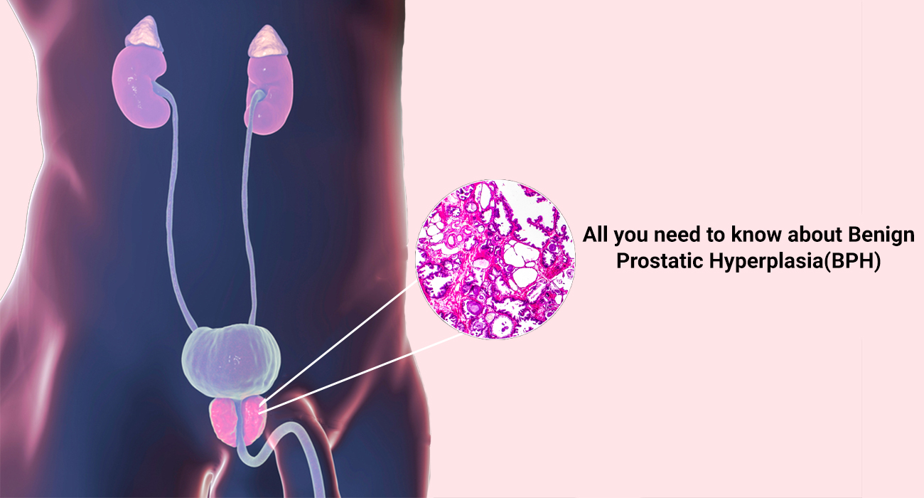 All you need to know about Benign Prostatic Hyperplasia(BPH)