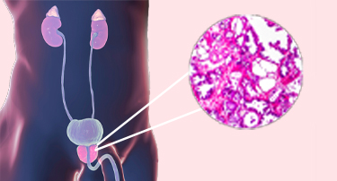 All you need to know about Benign Prostatic Hyperplasia(BPH)