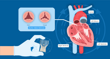 How does transcatheter aortic valve replacement help in treating heart conditions?