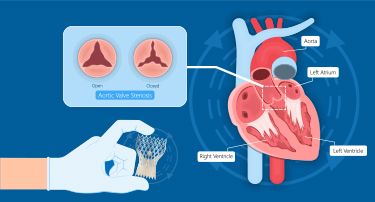 How does Transcatheter Aortic Valve replacement help in treating Heart conditions?