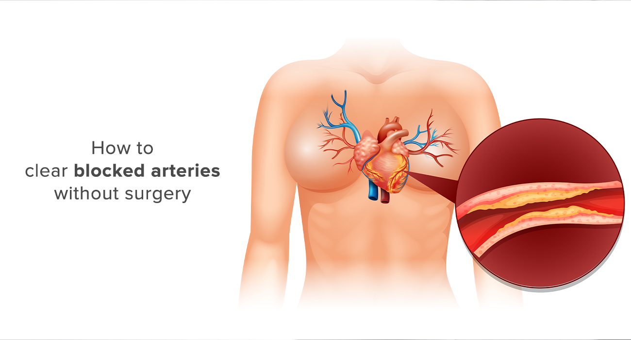 How to clear blocked arteries without surgery