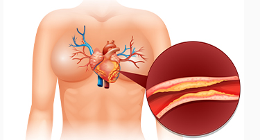 How to clear blocked arteries without surgery