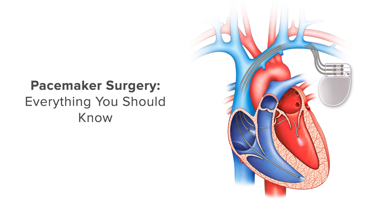 Pacemaker Surgery: Everything You Should Know