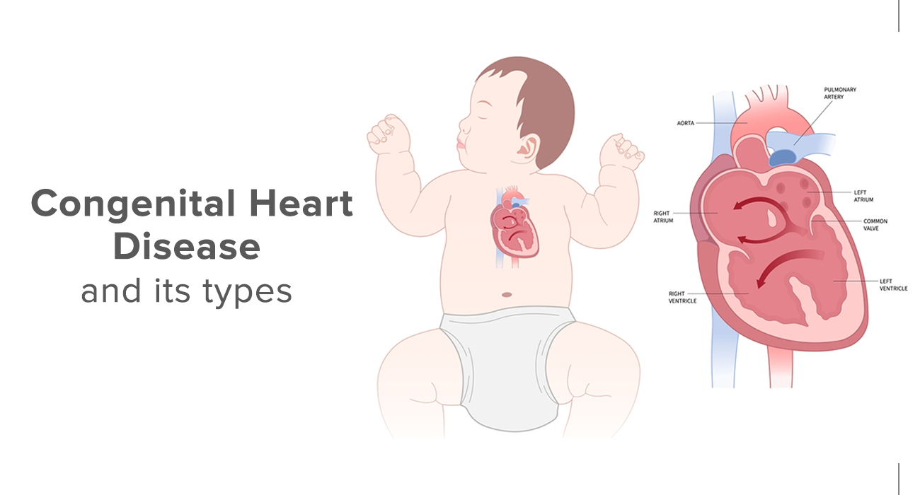 Congenital Heart Disease and Its Types