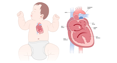Congenital Heart Disease and Its Types