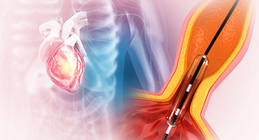 CT Angiography Vs. Angiography: What Is Best For You?