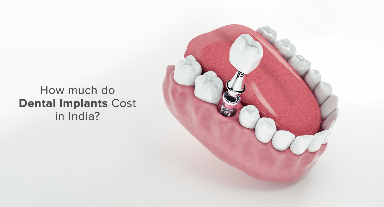How much do Dental Implants Cost in India?