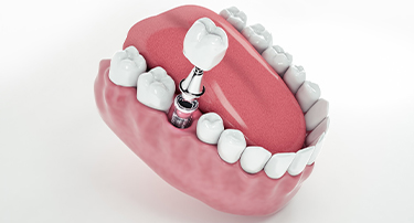 How much do Dental Implants Cost in India?