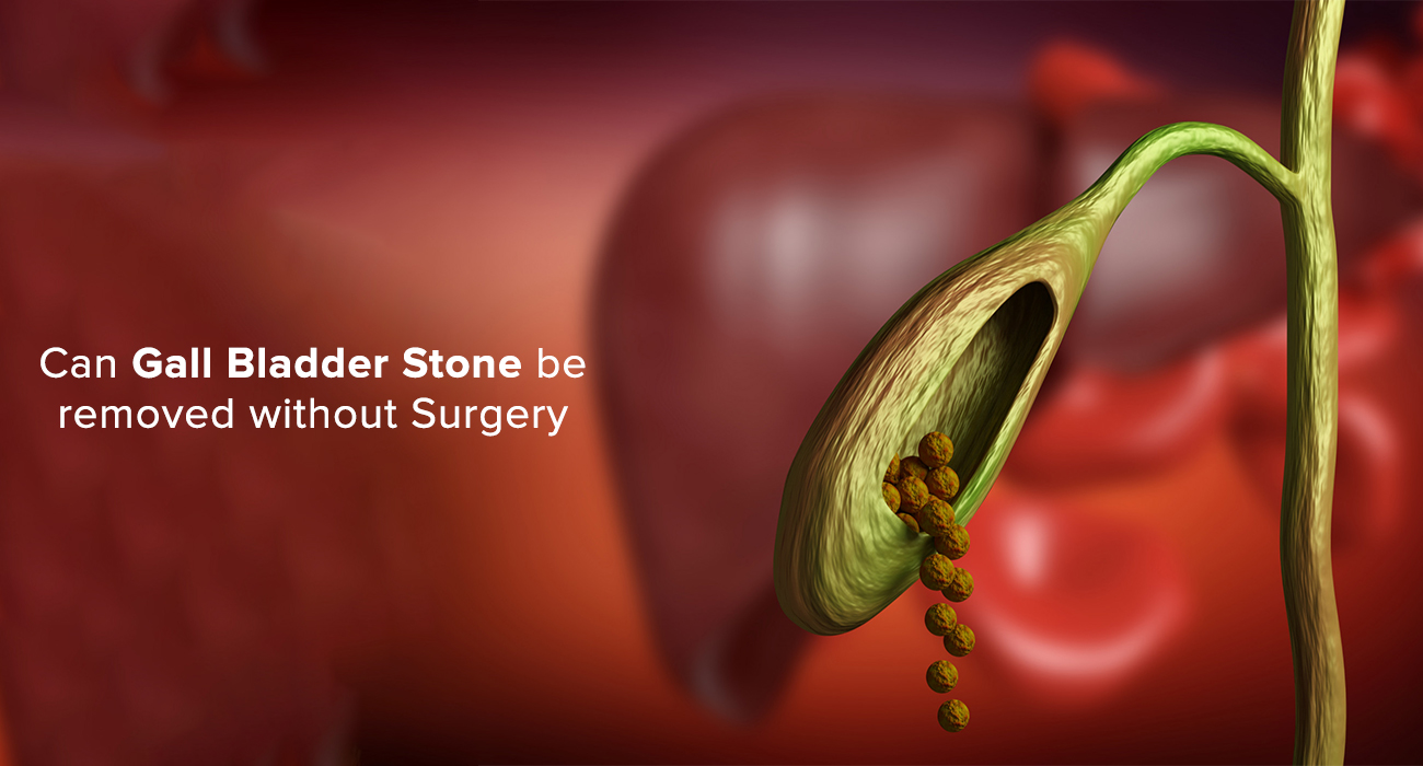 Can Gallbladder Stones Be Removed Without Surgery?