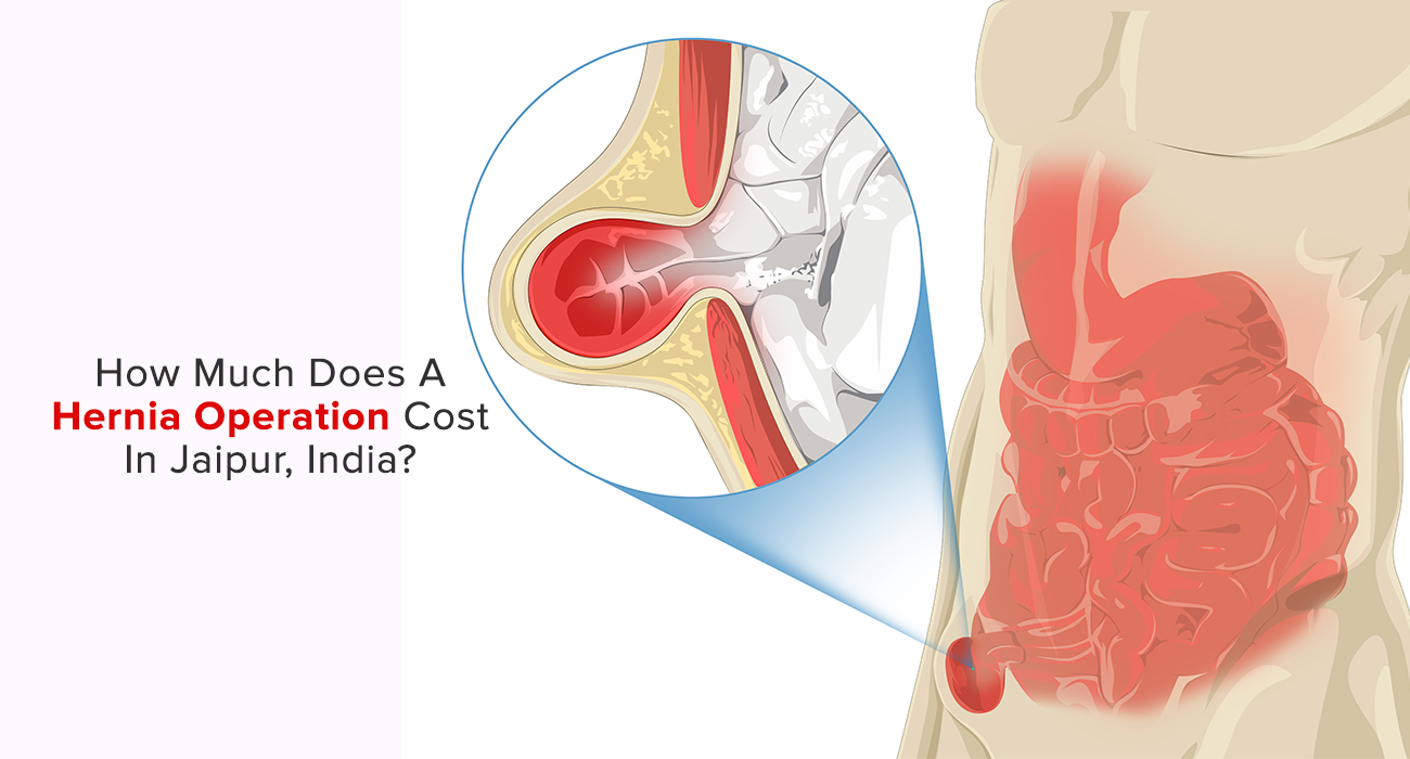 How Much Does A Hernia Operation Cost In Jaipur, India?