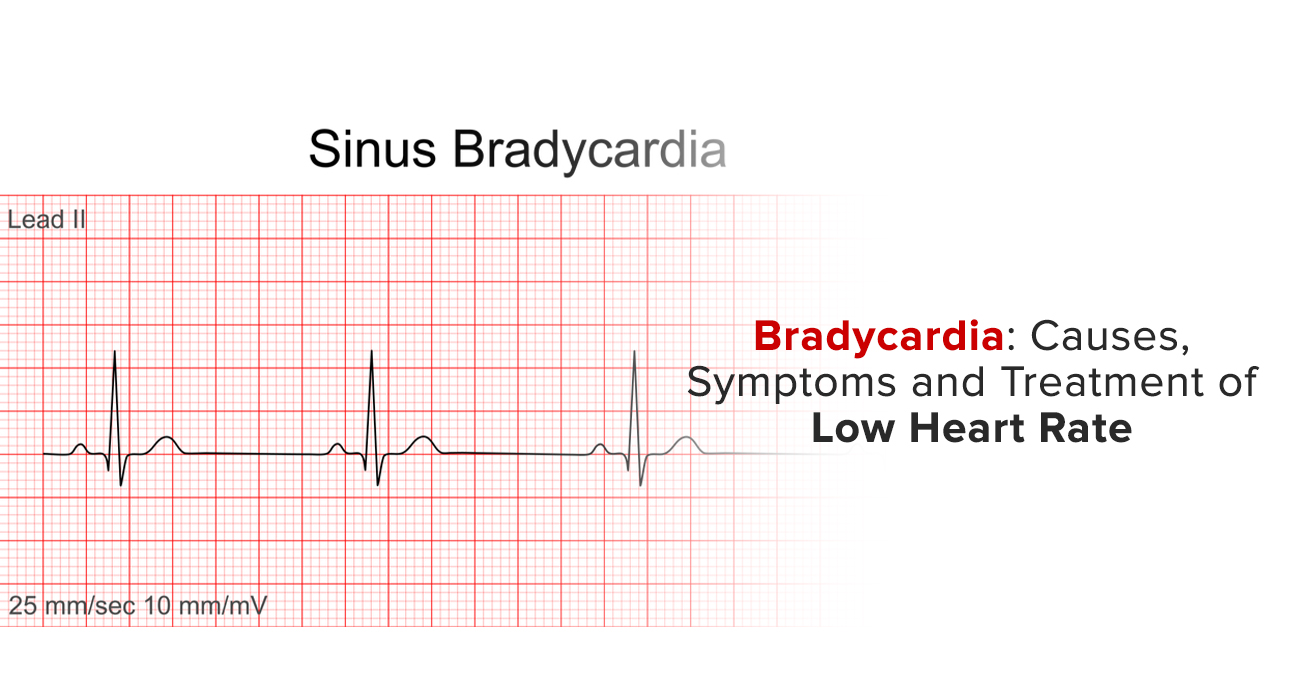 Bradycardia: Causes, Symptoms And Treatment Of Low Heart Rate