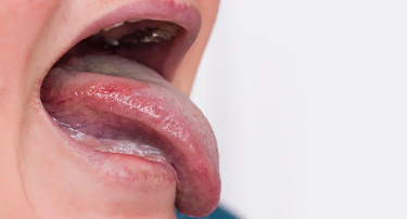 How to Identify & Treat Leukoplakia Patches: A Complete Guide