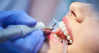 How Teeth Polishing Can Improve Your Oral Health & Smile
