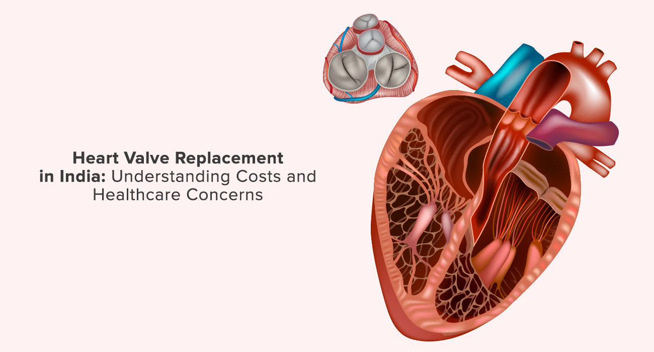 Heart Valve Replacement in India: Understanding Costs and Healthcare Concerns