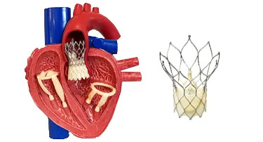 An Overview of Transcatheter Aortic Valve Implantation TAVI: What You Need to Know