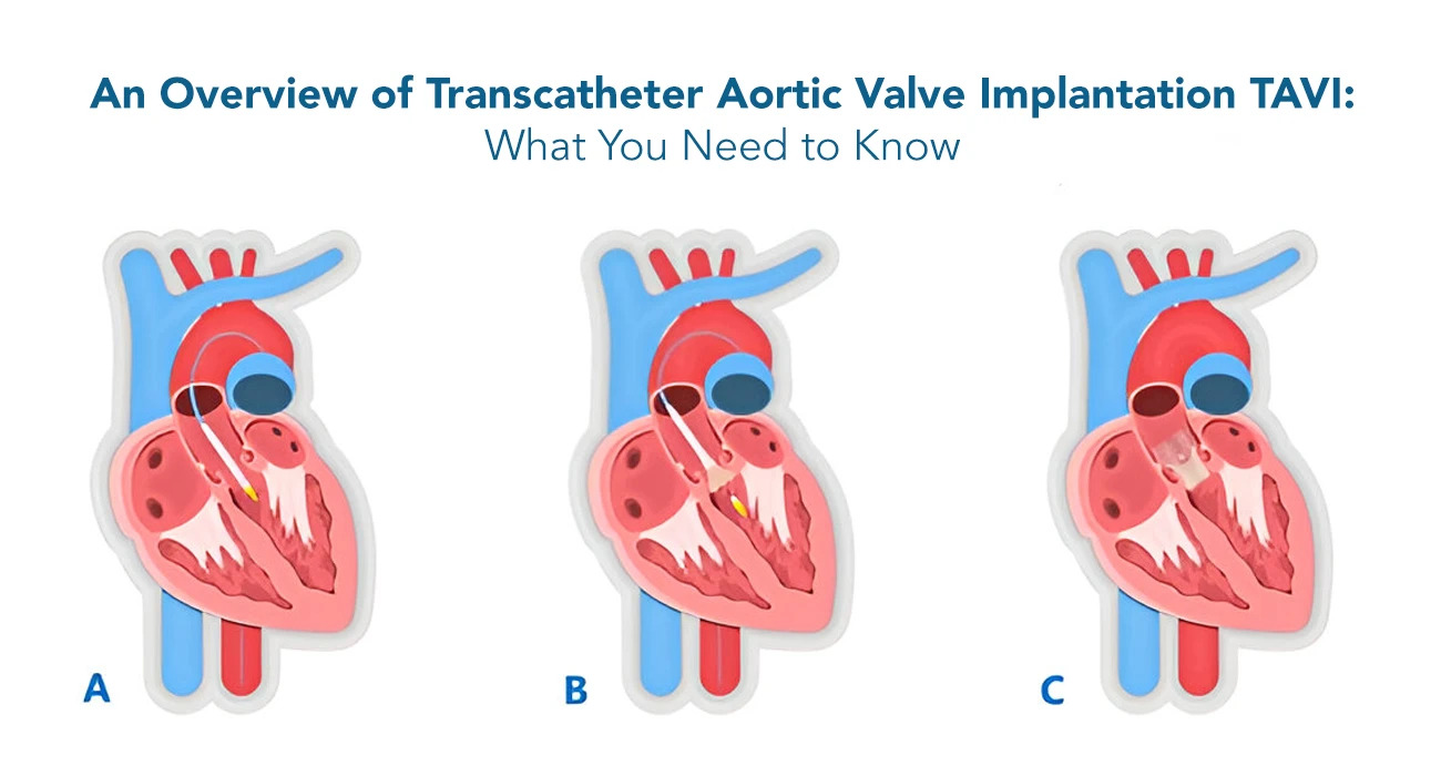 An Overview of Transcatheter Aortic Valve Implantation TAVI: What You Need to Know