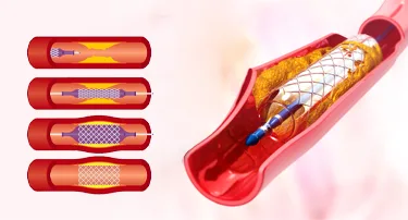 Understanding Angioplasty: Procedure Risks and Recovery