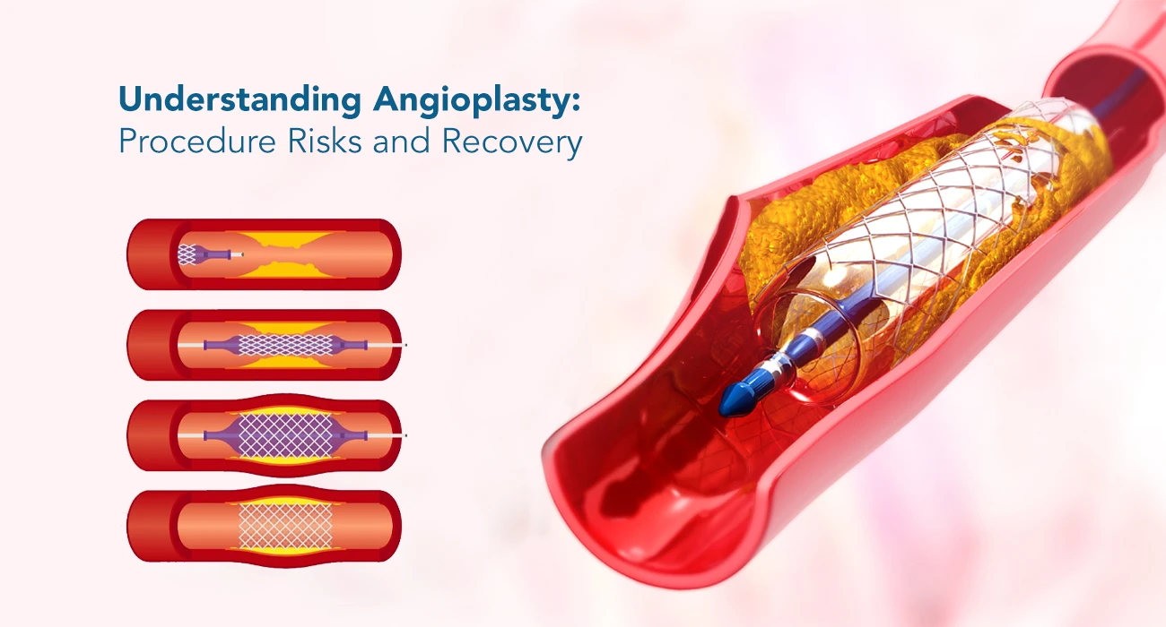 Understanding Angioplasty: Procedure Risks and Recovery