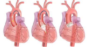 Advantages and Benefits of Transcatheter Aortic Valve Replacement Compared to Surgical Aortic Valve Replacement