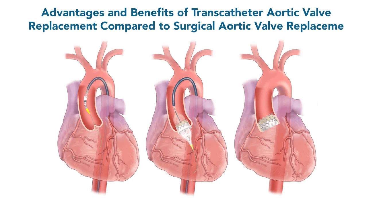 Advantages and Benefits of Transcatheter Aortic Valve Replacement Compared to Surgical Aortic Valve Replacement