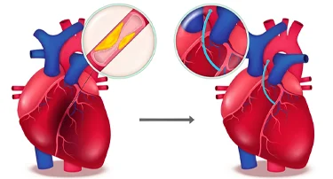 What is Coronary Heart Disease?