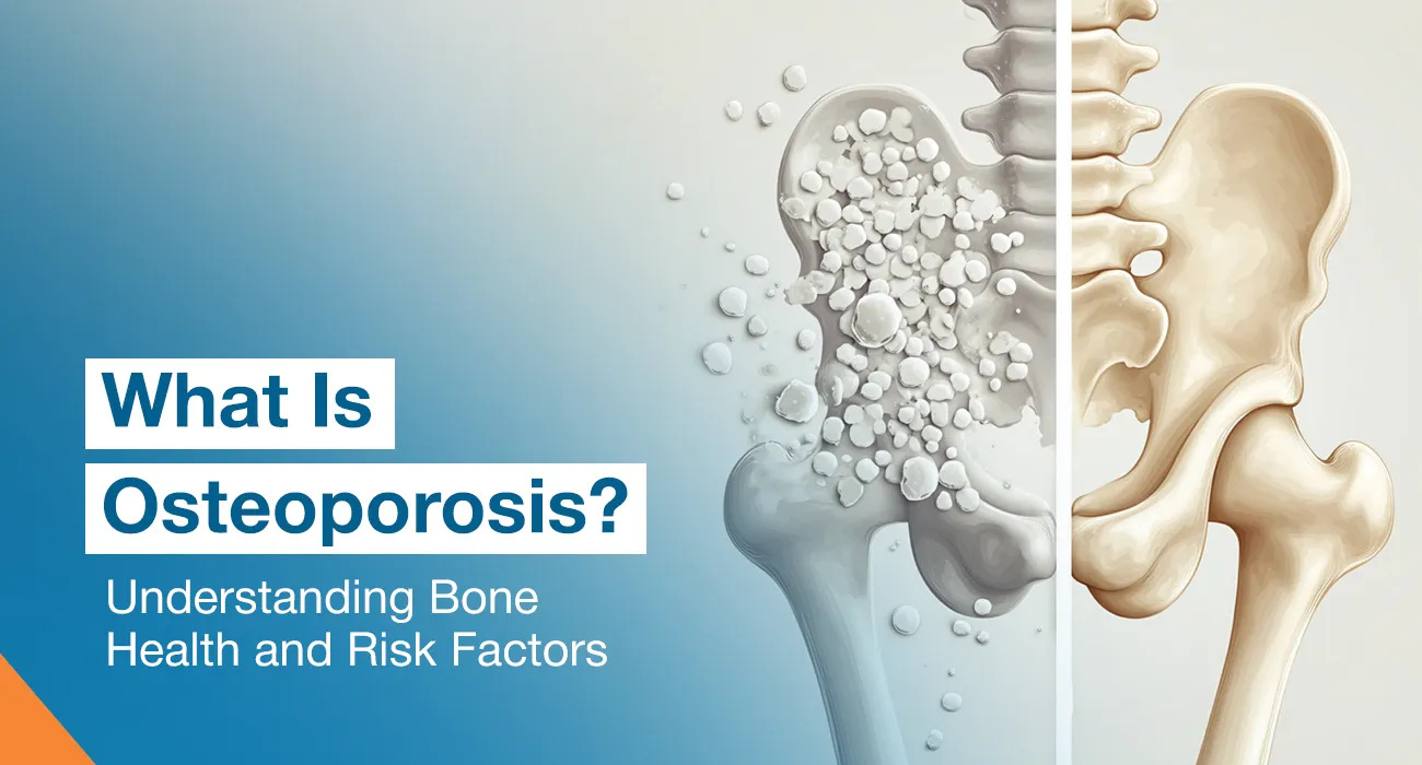 What Is Osteoporosis? Understanding Bone Health and Risk Factors