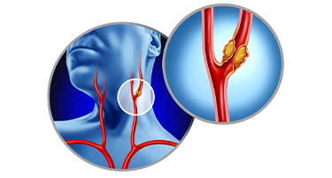 Carotid Stenting: A Life-Saving Procedure to Prevent Stroke
