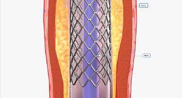 Carotid Artery Stenting vs Endarterectomy: Which Is Better for You