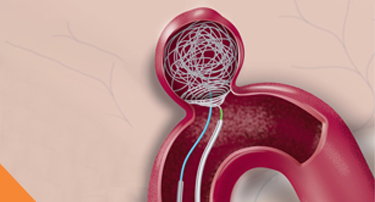 Aneurysm Coiling: How Modern Technology Prevents Brain Hemorrhage