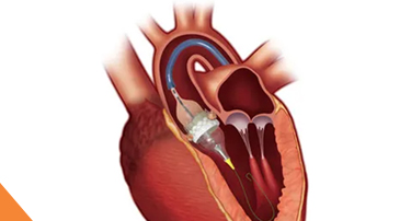 Modern Cardiac Care: The Role of TAVR in Structural Heart Disease Treatment