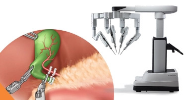 Advantages of Robotic Cholecystectomy Over Laparoscopic One