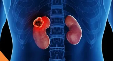 Kidney Cancer Surgery: Partial vs Radical Nephrectomy Explained