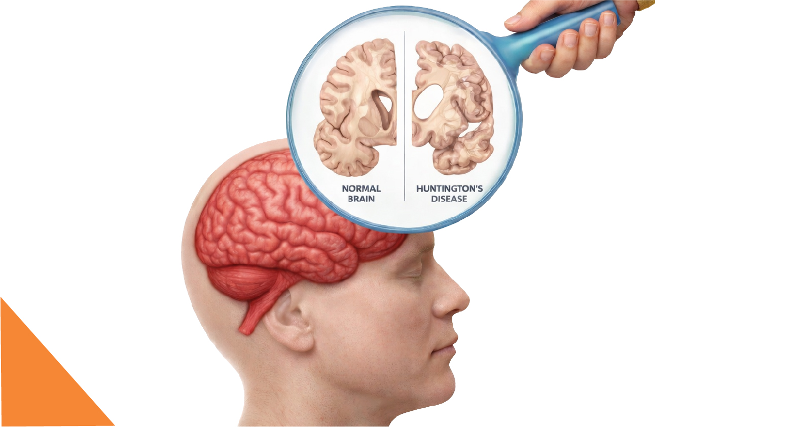Huntington’s Disease: Symptoms, Causes, and Expert Treatment in Jaipur