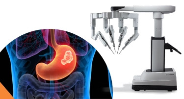How Robotic Surgery Is Transforming GI Cancer Treatment