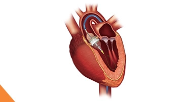 <p>If you have been recently diagnosed with severe aortic valve disease, the effective treatment is based on your age, overall health, heart anatomy</p>
