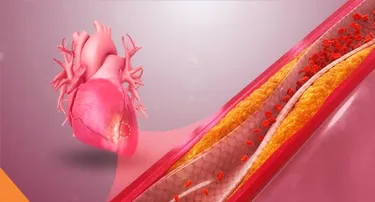 <p>Acute coronary syndrome (ACS) refers to a group of conditions that involve sudden reduction in blood flow to the heart.</p>
