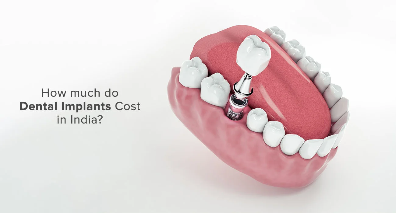 How much do Dental Implants Cost in India?