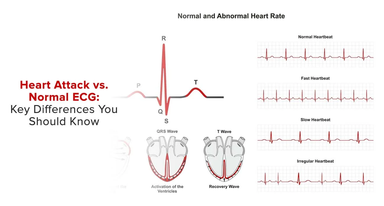 Heart Attack vs. Normal ECG: Key Differences You Should Know