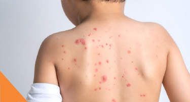 <p>Chickenpox symptoms generally start with:</p>

<ul>
	<li>fever,&nbsp;</li>
	<li>tiredness,&nbsp;</li>
</ul>
