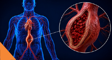 <p>An aortic aneurysm is a bulge in the wall of your aorta, the main artery from your heart.</p>
