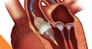 <p>Heart (cardiac) problems rarely announce their arrival with loud warnings. Most of the time, they start silently-a little breathlessness while climbing stairs</p>
